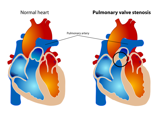 Image showing a comparison between a normal heart and one with Pulmonary Valve Stenosis